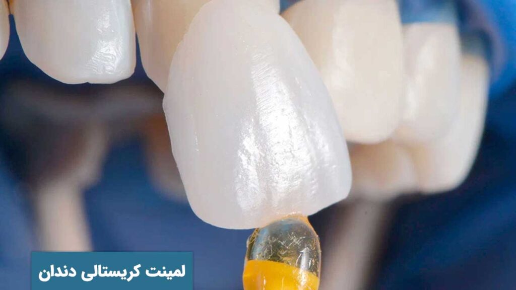 لمینت کریستالی دندان