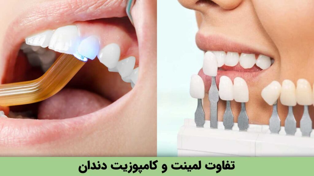 تفاوت لمینت و کامپوزیت دندان