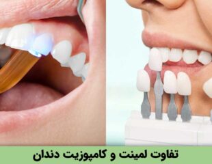 تفاوت لمینت و کامپوزیت دندان