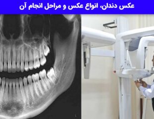 عکس دندان