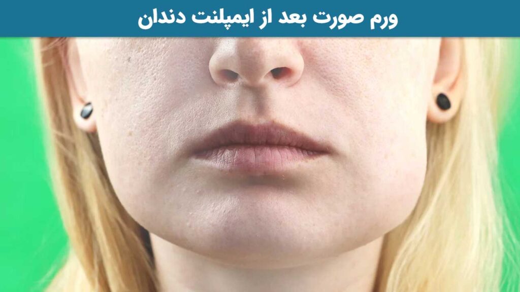ورم صورت بعد از ایمپلنت دندان