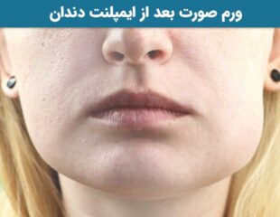ورم صورت بعد از ایمپلنت دندان