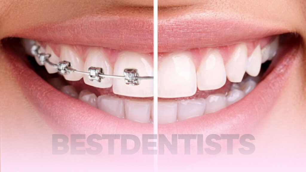 اصلاح طرح لبخند با ارتودنسی