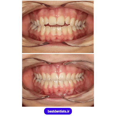 نمونه کار ارتودنسی دکتر احسان صانعی شماره 1