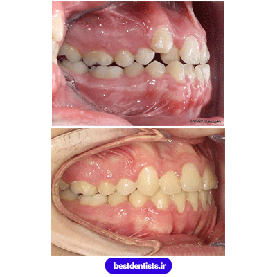 نمونه کار ارتودنسی دکتر احسان صانعی