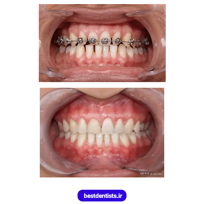 نمونه کار ارتودنسی دکتر احسان صانعی
