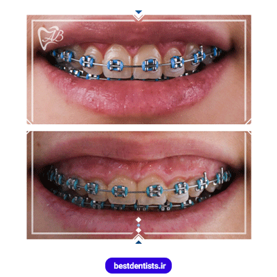 نمونه کار ارتودنسی دکتر علیرضا بغدادی شماره 1
