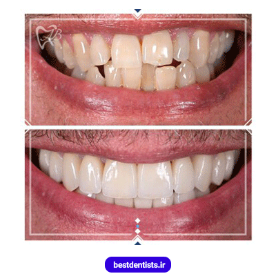 نمونه کار ارتودنسی دکتر علیرضا بغدادی