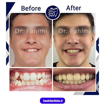 نمونه کار ارتودنسی دکتر مهدی فهیمی شماره 1