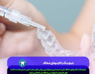 بلیچینگ با الاینرهای شفاف