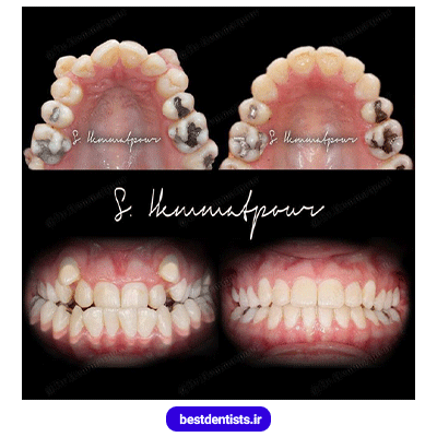 نمونه کار ارتودنسی دندان دکتر سیامک همت پور شماره 1