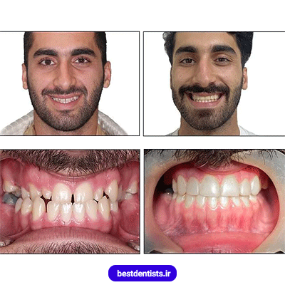 نمونه کار ارتودنسی دکتر نگار حدادی شماره 1