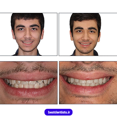 نمونه کار ارتودنسی دکتر نگار حدادی شماره 2