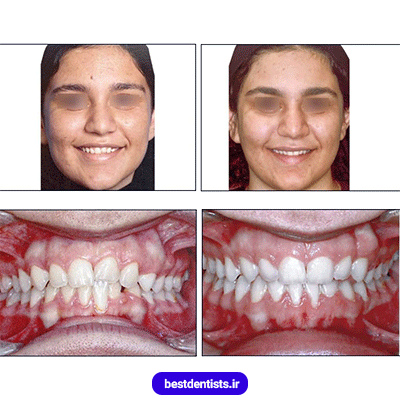 نمونه کار ارتودنسی دکتر نگار حدادی شماره 3