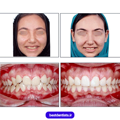 نمونه کار ارتودنسی دکتر نگار حدادی شماره 4