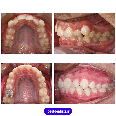 نمونه کار ارتودنسی دکتر نگار حدادی شماره 5