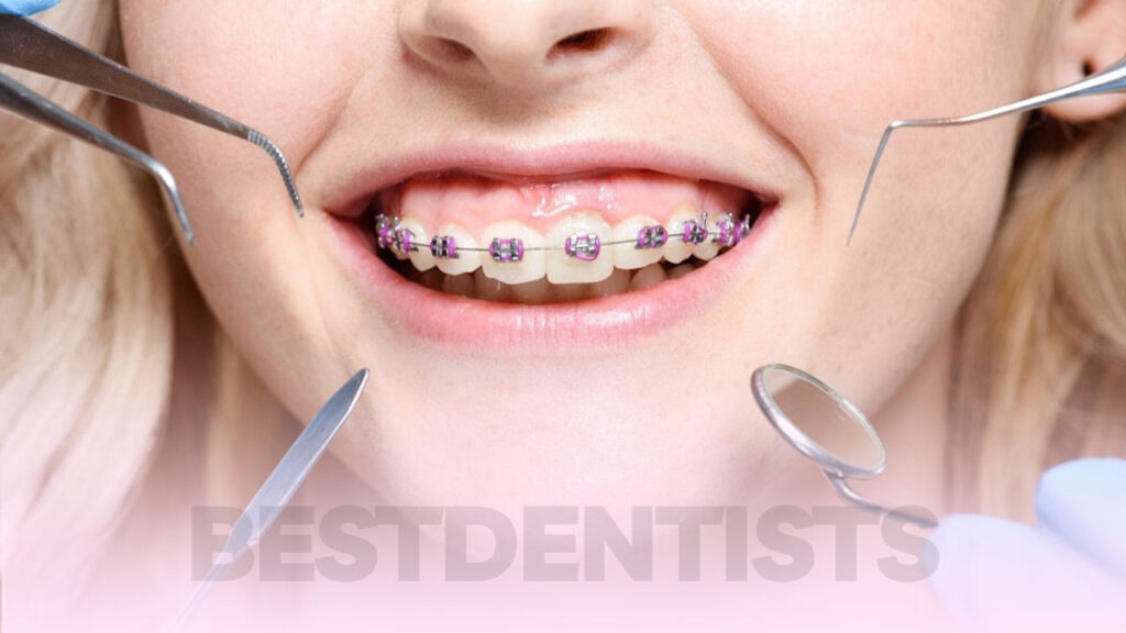 عکسی از لبخند خانمی با دندان های حاوی بریس های ارتودنسی ثابت