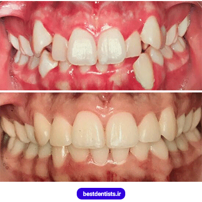 نمونه کار قبل و بعد ارتودنسی دکتر سهیل سالاری