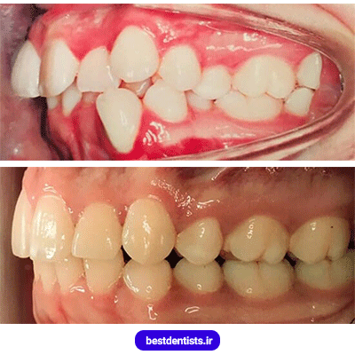 نمونه کار قبل و بعد ارتودنسی دکتر سهیل سالاری شماره 2