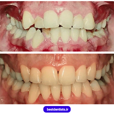 نمونه کار قبل و بعد ارتودنسی دکتر سهیل سالاری