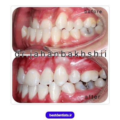 نمونه کار قبل و بعد ارتودنسی دکتر محمدرضا جهانبخشی شماره 1